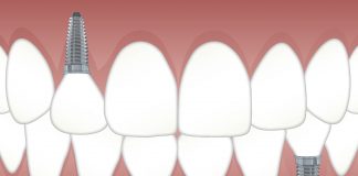 implant dentar în Bucureşti